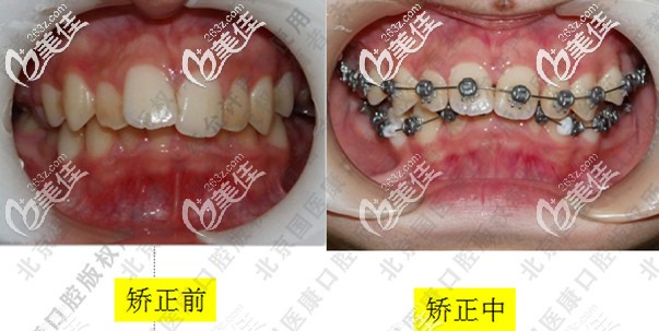 深覆合矫正前牙齿的照片 深覆合矫正前牙齿的照片