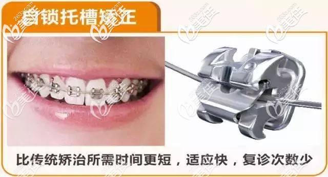 自锁托槽矫正器的特点 自锁托槽矫正器的特点
