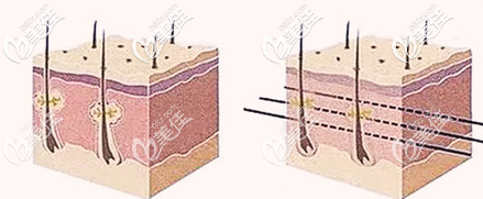 济南艺星埋线提升的示意图 济南艺星埋线提升的示意图