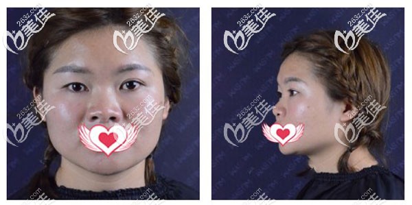 隆鼻手术前 隆鼻手术前