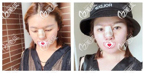 硅胶鼻第7天肿胀消退可以拆线 硅胶鼻第7天肿胀消退可以拆线