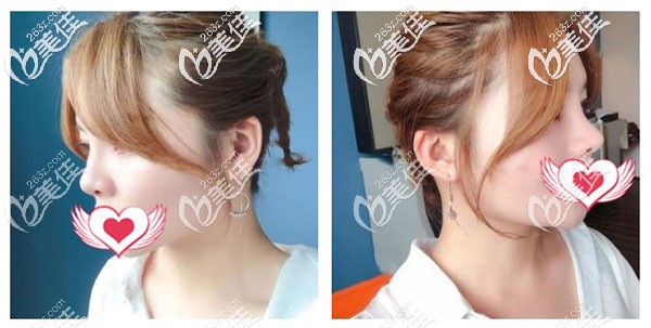 垫鼻尖一个月假体已经稳定 垫鼻尖一个月假体已经稳定