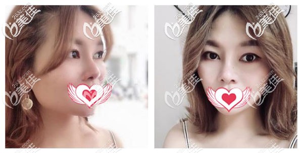 硅胶鼻2个月的恢复效果图 硅胶鼻2个月的恢复效果图