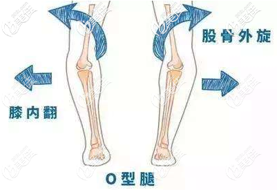 北京禾美嘉医疗美容诊所O型腿矫正原理