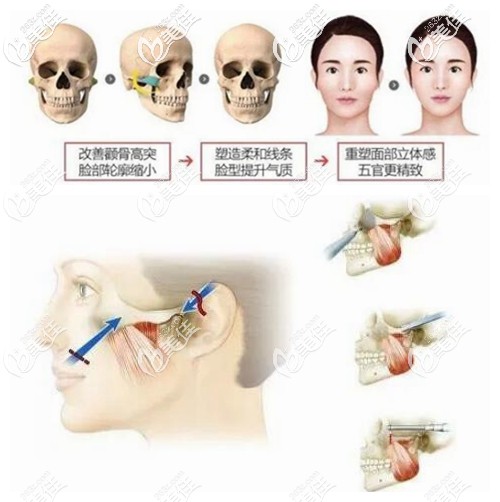 颧弓内推手术原理示意图