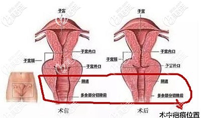 阴道紧缩手术的原理 阴道紧缩手术的原理