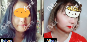 杨季涛鼻修复真人<span style= 杨季涛鼻修复真人<span style=