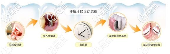 种植牙步骤