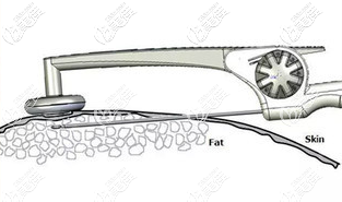 黄金微雕抽脂瘦身原理示意图