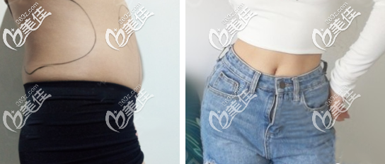 我做的黄金微雕腰腹部环吸案例效果图