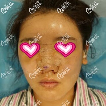 鼻综合+自体脂肪全脸填充术后第1天照