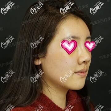 鼻综合术后第8天拆线