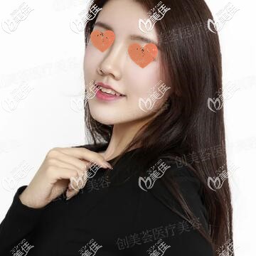 鼻综合+自体脂肪全脸填充术后第17天照