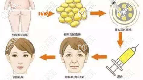 面部自体脂肪填充的过程