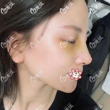 重庆军科鼻综合术后一周