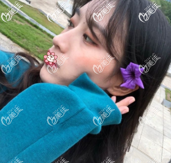 重庆军科林勇假体隆鼻术后40天