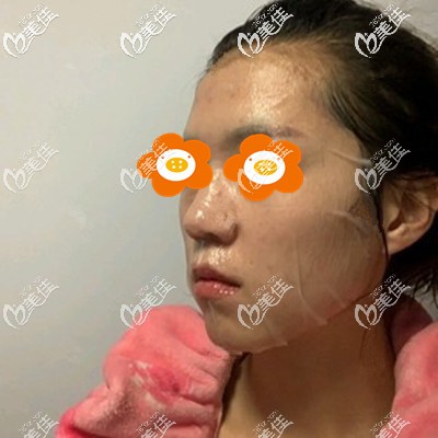 术后第3天敷着面膜