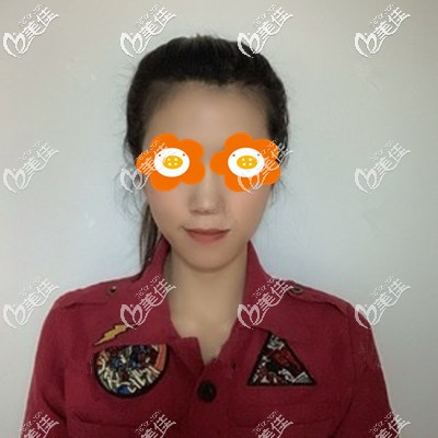 面部埋线提升术后一周效果