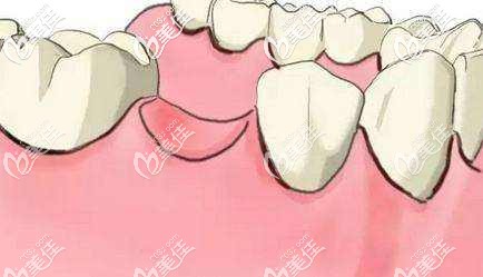 门牙缺失怎么修复 门牙缺失怎么修复