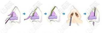 驼峰鼻矫正手术过程示意图