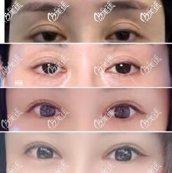 大楼爱得丽格刘志刚双眼皮修复眼睛效果和价格