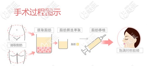 面部脂肪填充手术过程