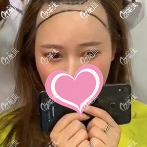 手术前一直后退的发际线 手术前一直后退的发际线