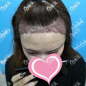 发际线种植后有轻微种植和流血 发际线种植后有轻微种植和流血