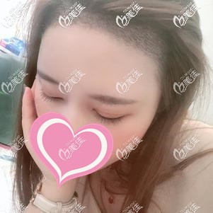 种植发际线术后30天血痂基本消除 种植发际线术后30天血痂基本消除