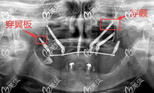 什么是穿颧穿翼板种植牙技术