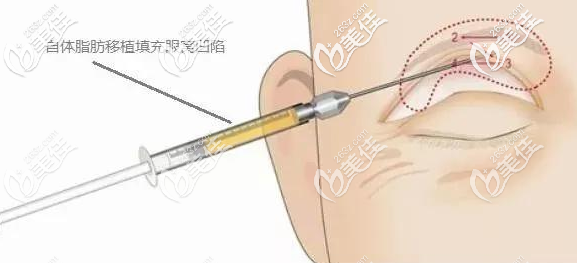 自体脂肪注射眼窝手术示意图