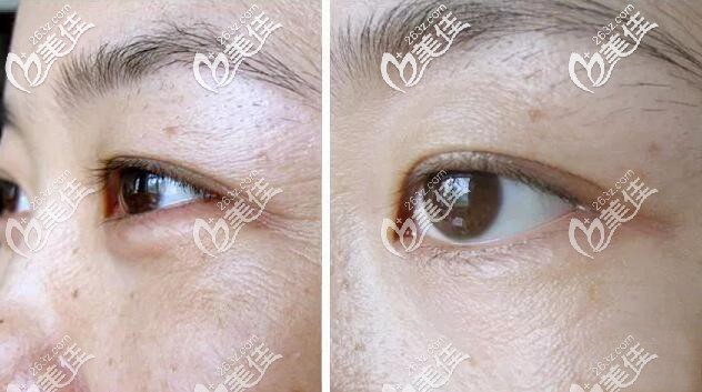 热玛吉治疗效果 热玛吉治疗效果