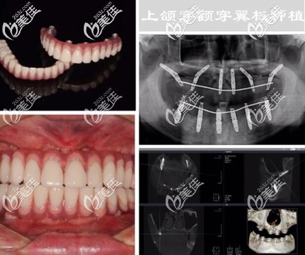 上颌牙槽骨不足做穿颧穿翼板种植牙案例