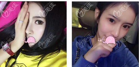 耳软骨复合隆鼻侧脸效果图