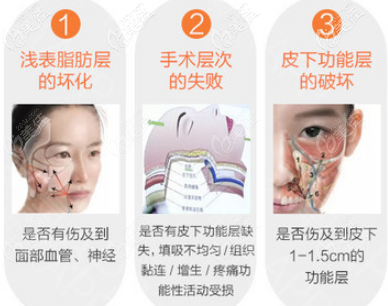 重庆郑荃丽格脂肪填充失败修复