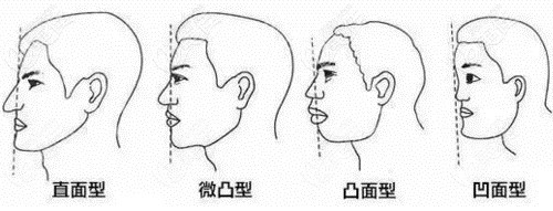 鼻基底凹陷的几种情况