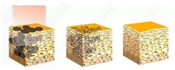 温州名人激光祛斑优势