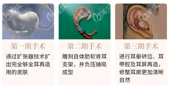耳再造手术治疗过程图