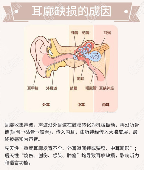 耳廓缺损的原因
