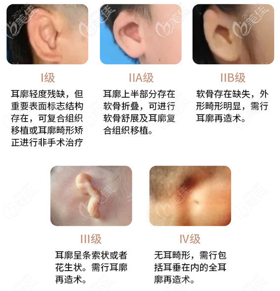 先天性小耳畸形几种类型图