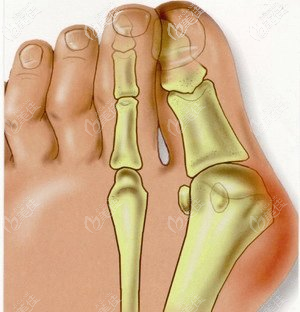 拇指外翻需要做手术 拇指外翻需要做手术