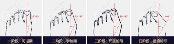 大脚骨的几个阶段 大脚骨的几个阶段