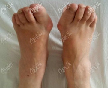 大脚骨图片 大脚骨图片