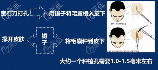 植发手术种植过程