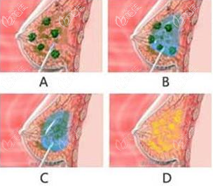 隆胸注射的奥美定和英捷尔法勒都是要取出的