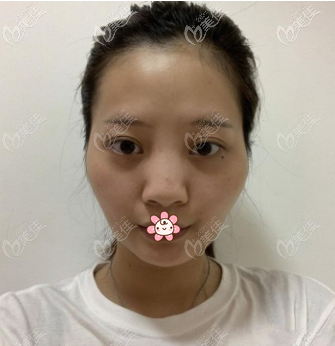 术前的我 术前的我