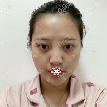 陶亮医生给我做完脂肪填充一周 陶亮医生给我做完脂肪填充一周