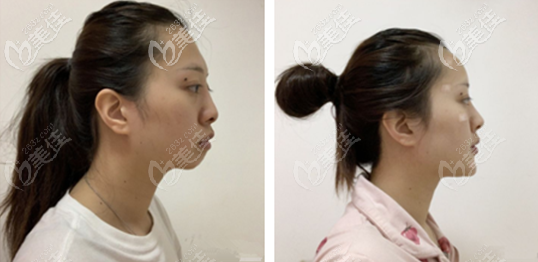 前后对比照片 前后对比照片