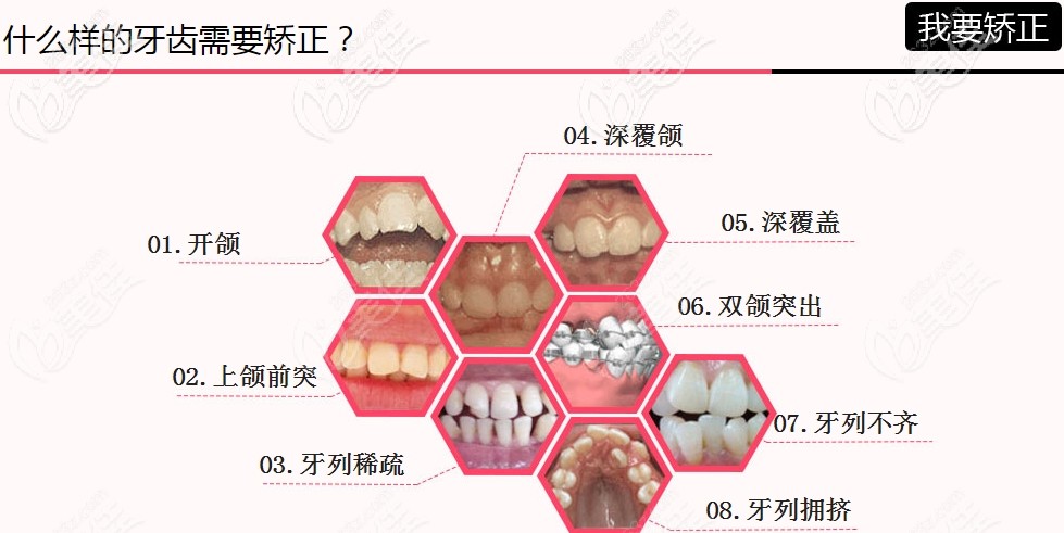 什么样的牙齿需要矫正