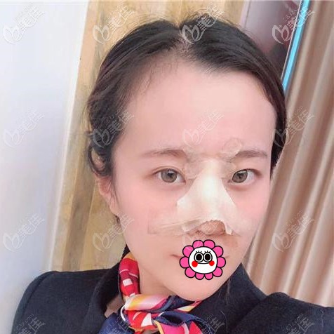 肋软骨隆鼻术后恢复五天效果 肋软骨隆鼻术后恢复五天效果